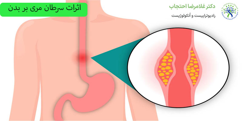 اثرات-سرطان-مری