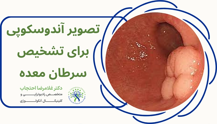 آندوسکوپی سرطان معده