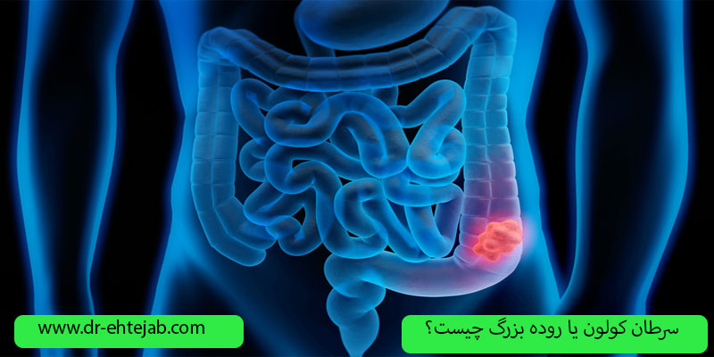 سرطان-کولون