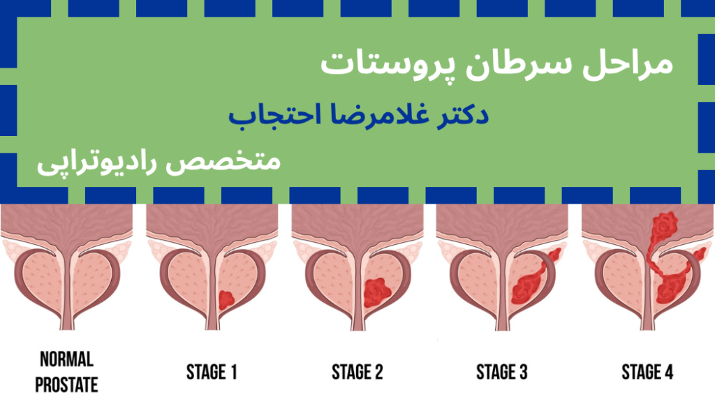 مراحل سرطان پروستات