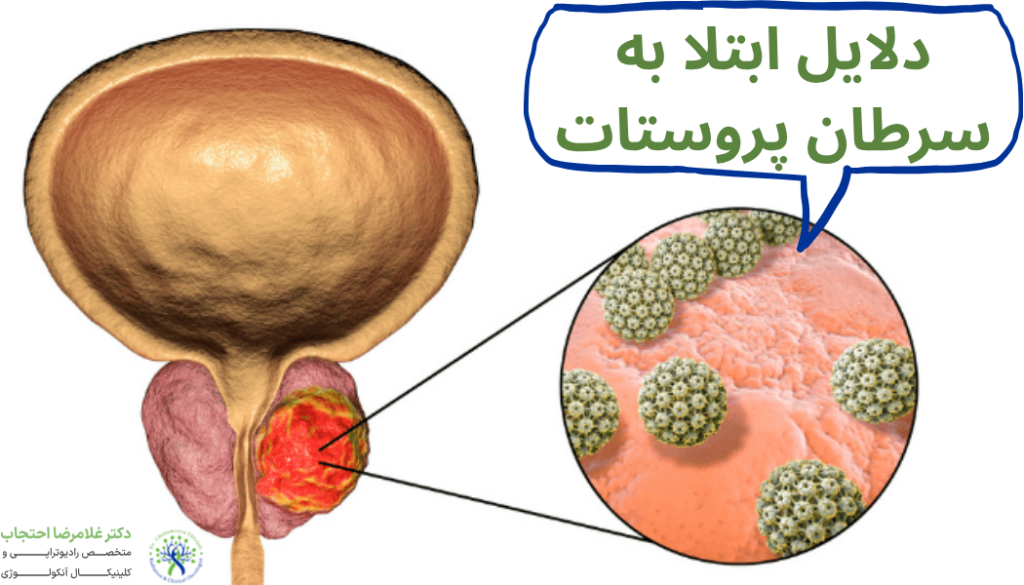 عوامل خطر ابتلا به سرطان پروستات