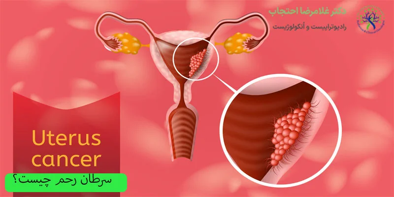 سرطان-رحم-چیست؟