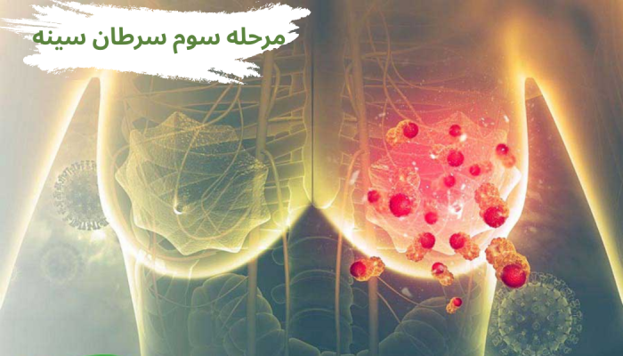 مرحله سوم سرطان سینه