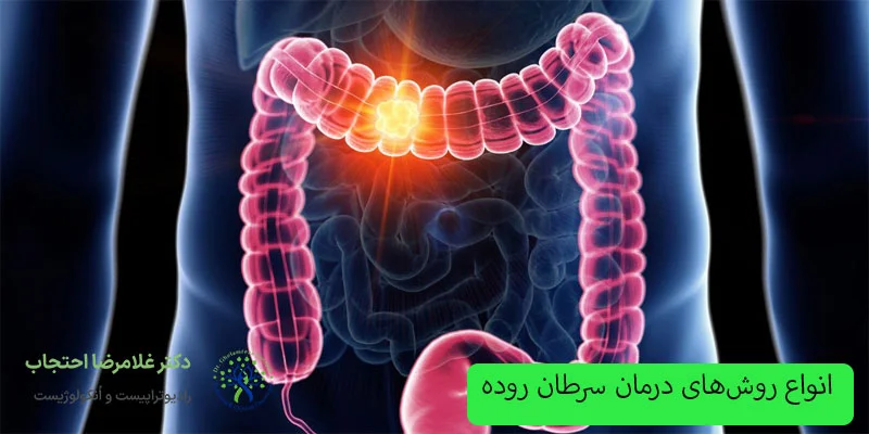 انواع-روش_های-درمان-سرطان-روده