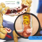 درمان-سرطان-روده (1)