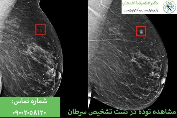 توده از علائم سرطان پستان
