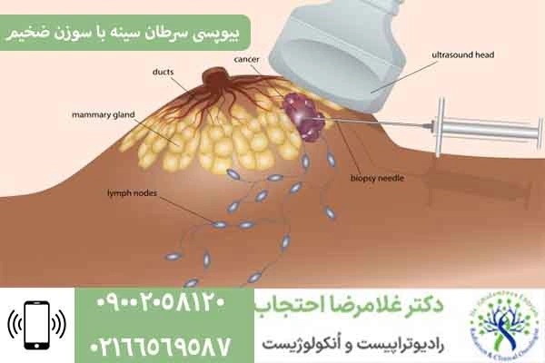 نمونه برداری از سرطان سینه با سوزن
