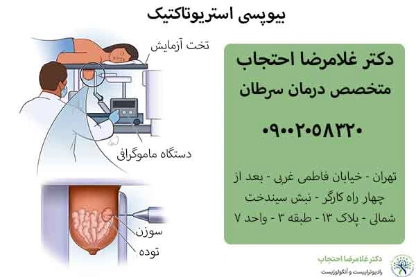 بیوپسی استریوتاکتیک سرطان سینه
