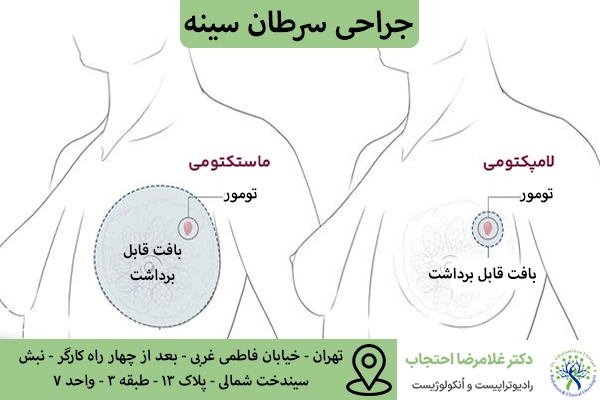 انواع جراحی سرطان سینه