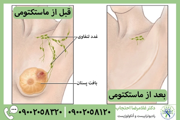 ماستکتومی
