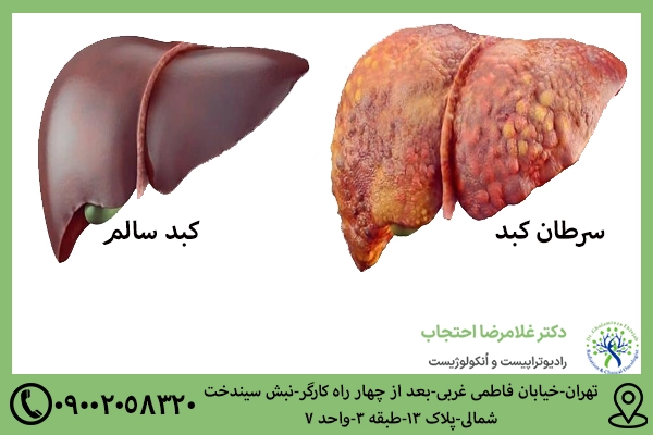 سرطان کبد