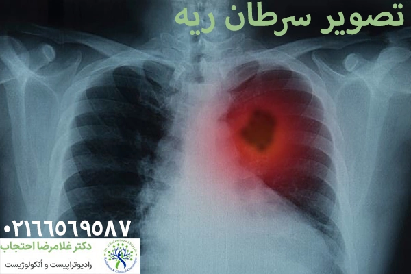 علائم سرطان ریه در اطراف مری