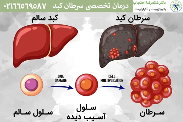 درمان تخصصی سرطان کبد