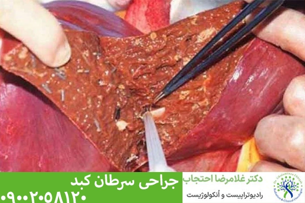 جراحی سرطان کبد