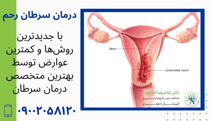درمان سرطان رحم