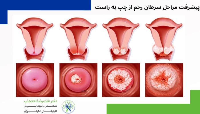 مراحل پیشرفت سرطان رحم