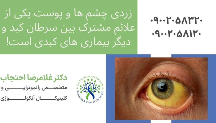 زردی چشم از علائم سرطان کبد