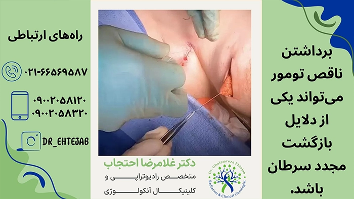 برداشتن ناقص تومور سرطانی