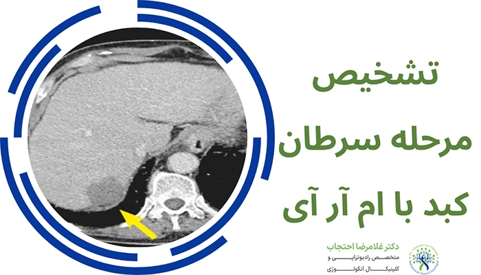 تشخیص مراحل سرطان کبد