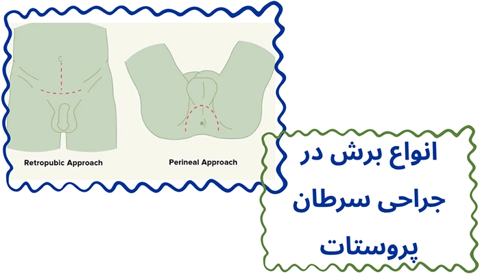 جراحی سرطان پروستات