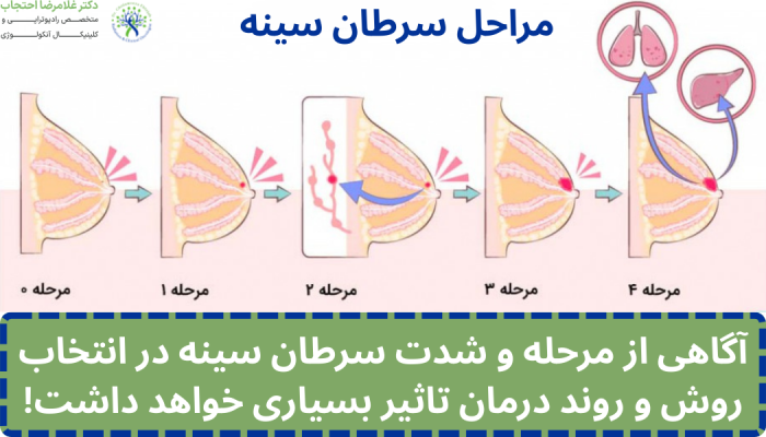 مراحل سرطان سینه